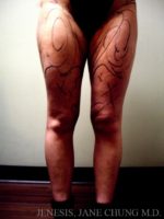 Thighs, Calves, and Ankles Liposuction
