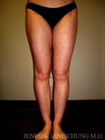 Thighs, Calves, and Ankles Liposuction