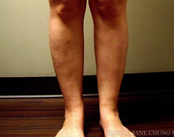Thighs, Calves, and Ankles Liposuction