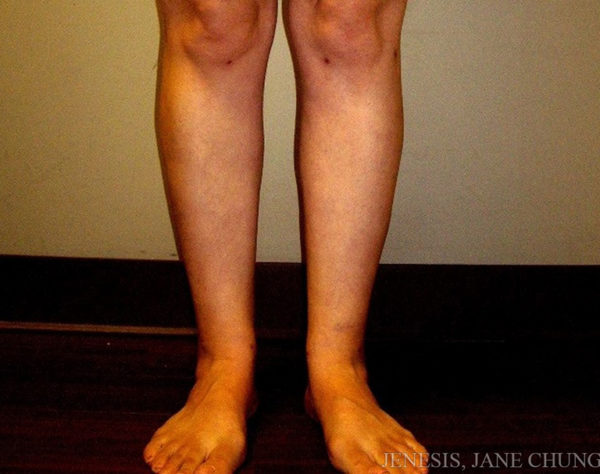 Thighs, Calves, and Ankles Liposuction