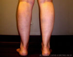 Thighs, Calves, and Ankles Liposuction