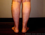 Thighs, Calves, and Ankles Liposuction