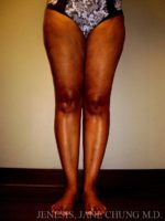 Thighs, Calves, and Ankles Liposuction