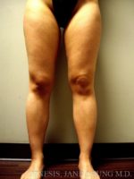 Thighs, Calves, and Ankles Liposuction