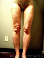 Thighs, Calves, and Ankles Liposuction