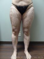 Thighs, Calves, and Ankles Liposuction