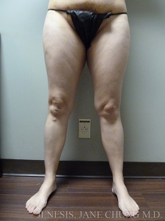 Thighs, Calves, and Ankles Liposuction
