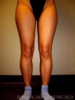 Thighs, Calves, and Ankles Liposuction