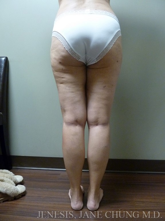 Thighs, Calves, and Ankles Liposuction