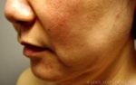 Buccal Fat Removal