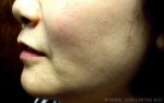 Buccal Fat Removal