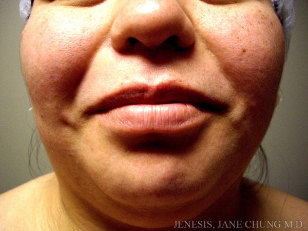 Buccal Fat Removal