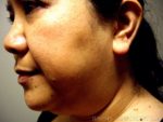 Buccal Fat Removal