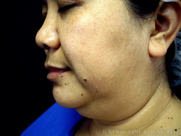 Buccal Fat Removal