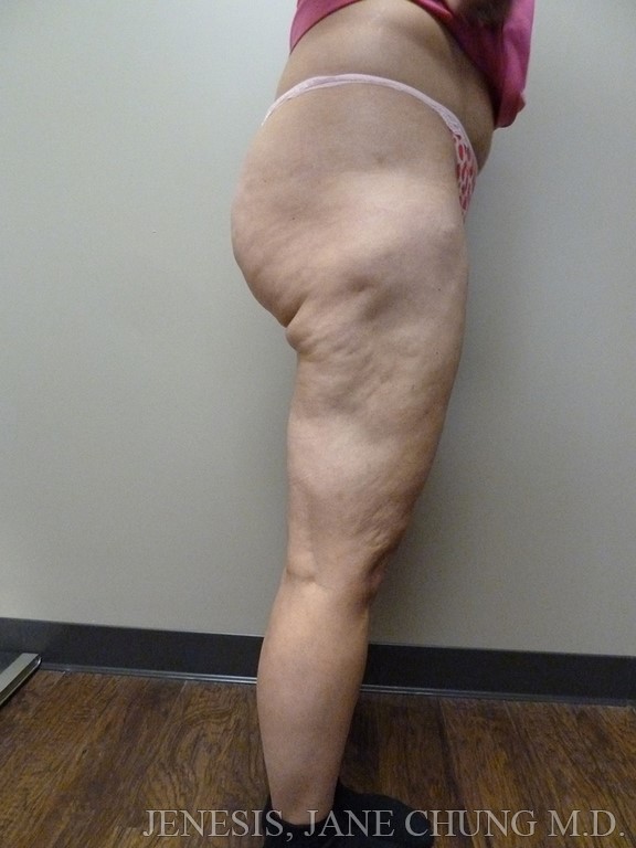 Revision Liposuction