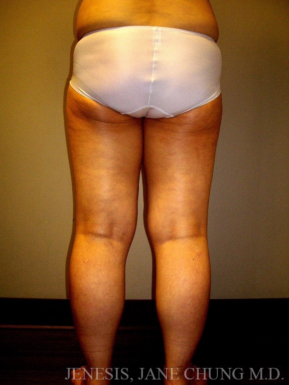 Revision Liposuction