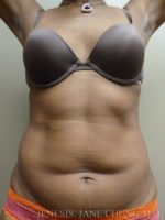 Revision Liposuction