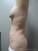 Revision Liposuction