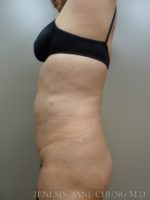 Revision Liposuction