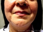 Liposuction Face & Neck