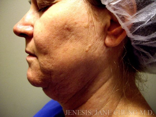 Liposuction Face & Neck