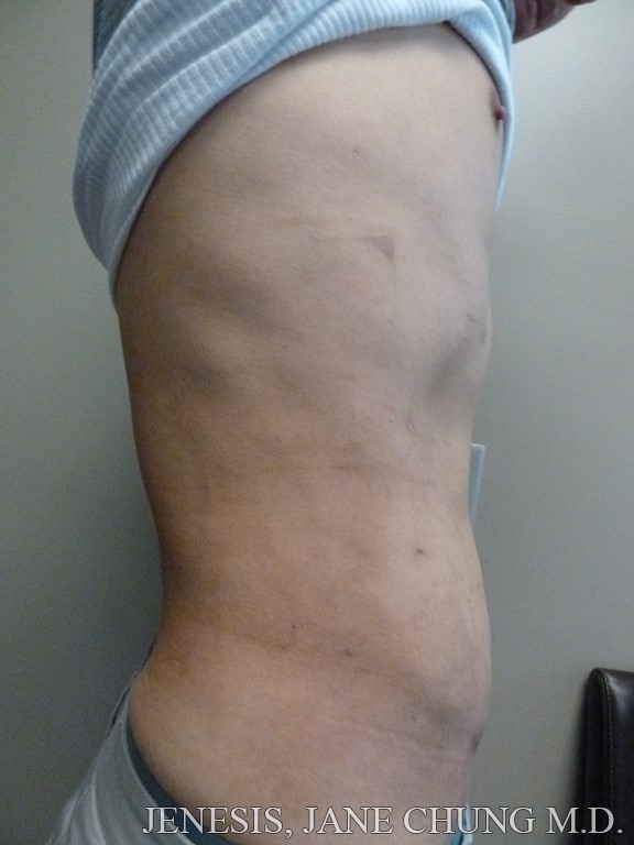 Vaser Hi Def Liposelection