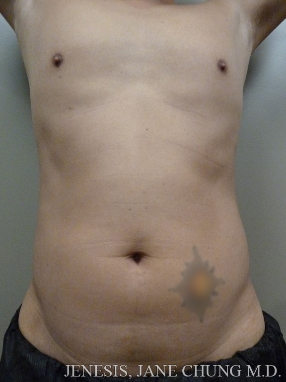 Vaser Hi Def Liposelection