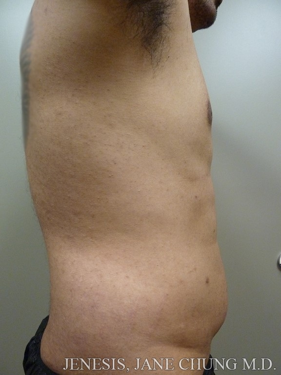 Vaser Hi Def Liposelection