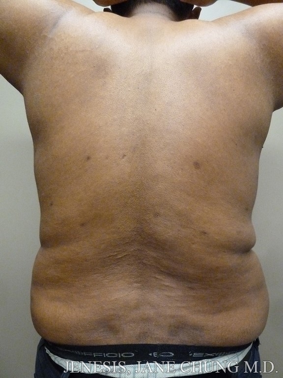 Vaser Hi Def Liposelection