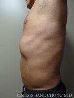 Vaser Hi Def Liposelection