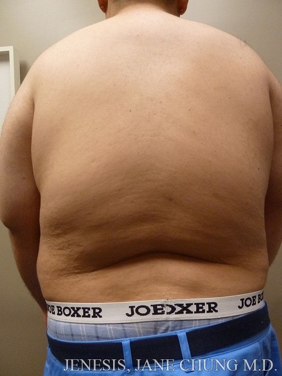 Vaser Hi Def Liposelection