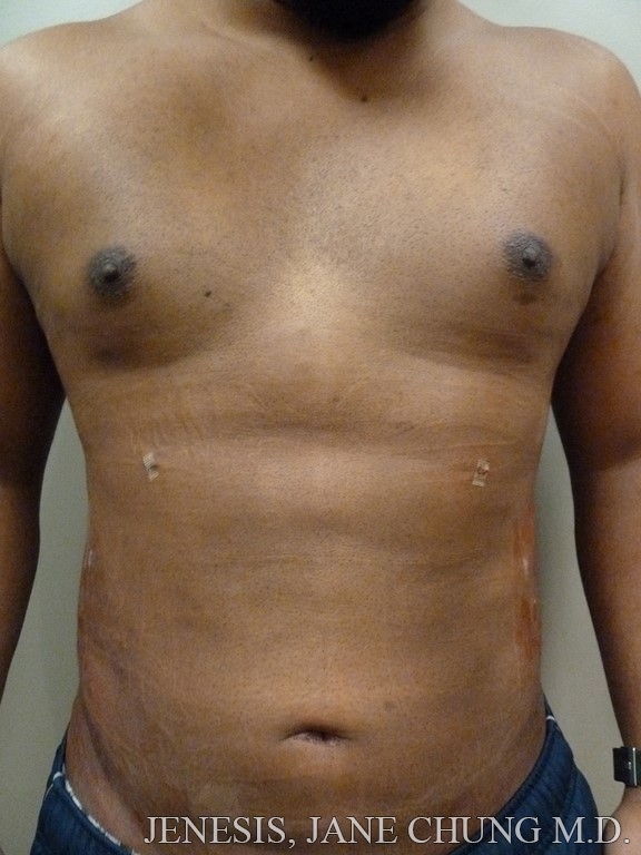 Vaser Hi Def Liposelection