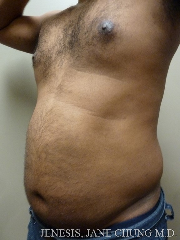 Vaser Hi Def Liposelection