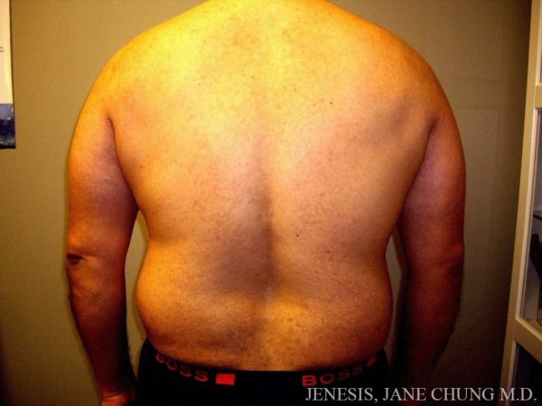 Vaser Hi Def Liposelection