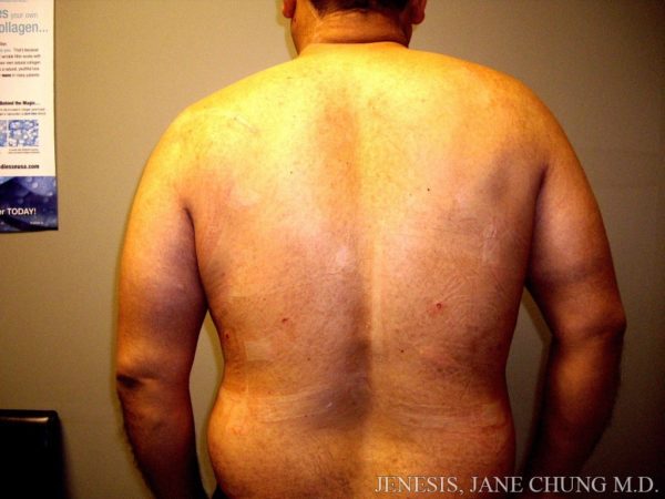 Vaser Hi Def Liposelection