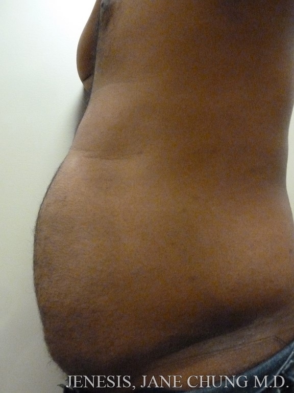 Vaser Hi Def Liposelection