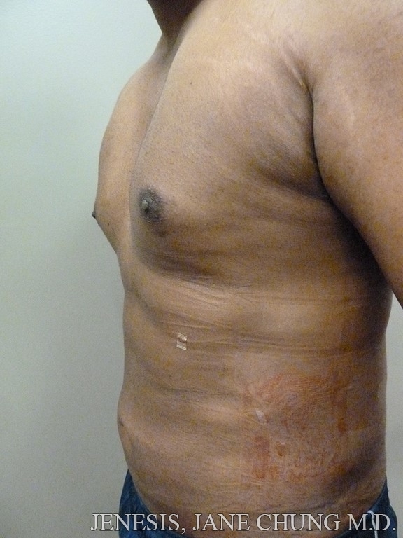 Vaser Hi Def Liposelection