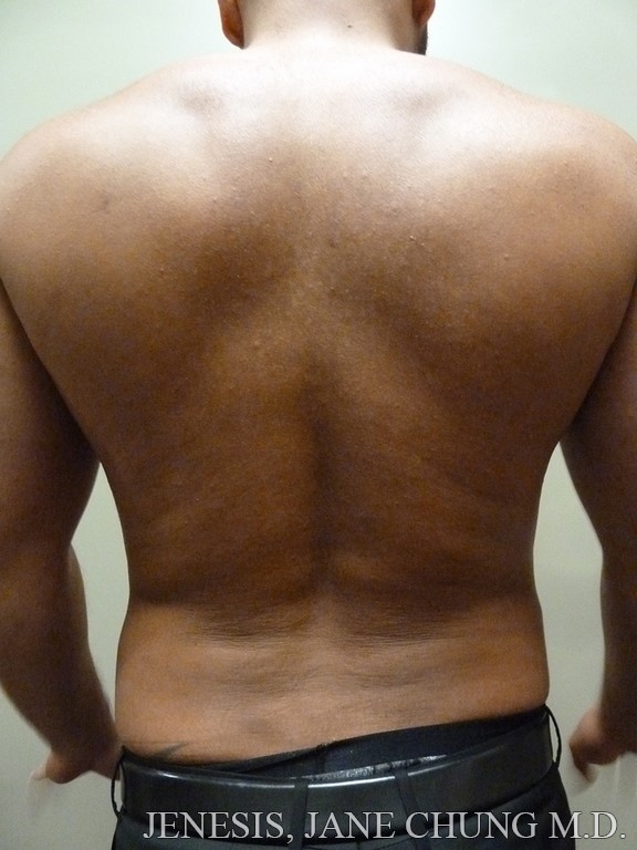 Vaser Hi Def Liposelection