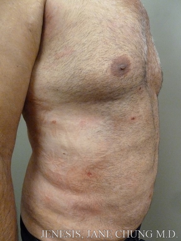 Vaser Hi Def Liposelection