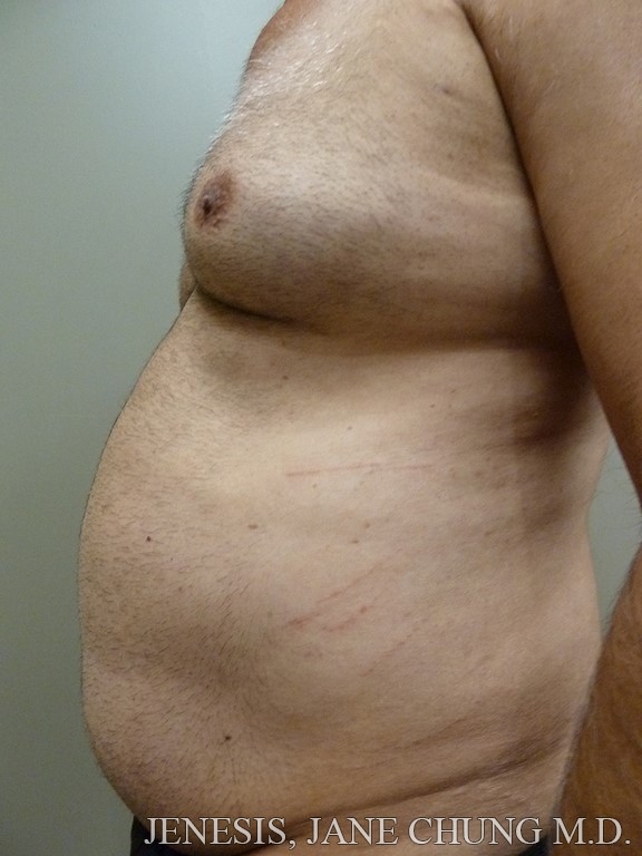 Vaser Hi Def Liposelection