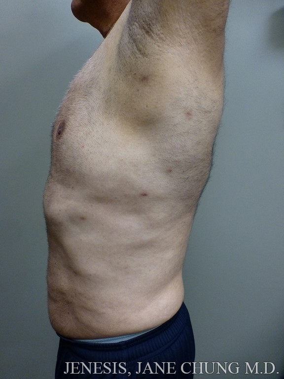 Vaser Hi Def Liposelection