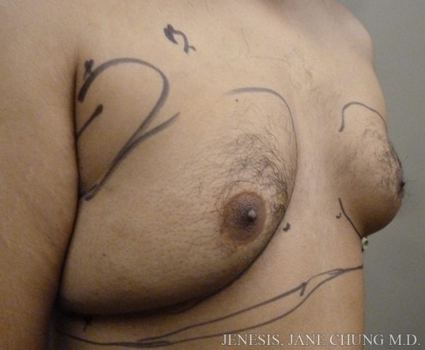 Gynecomastia