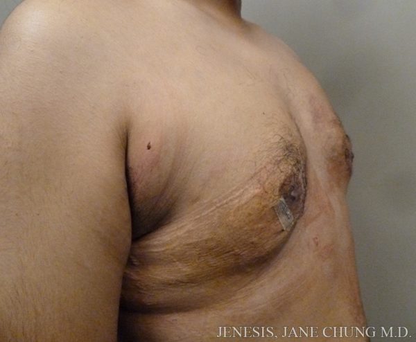 Gynecomastia