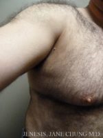 Gynecomastia