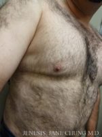 Gynecomastia