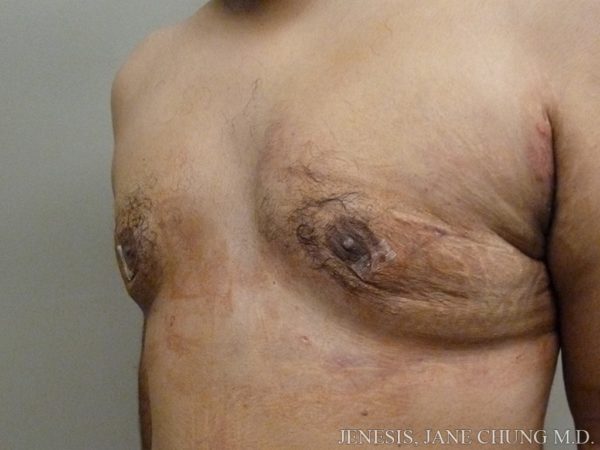 Gynecomastia