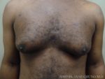 Gynecomastia