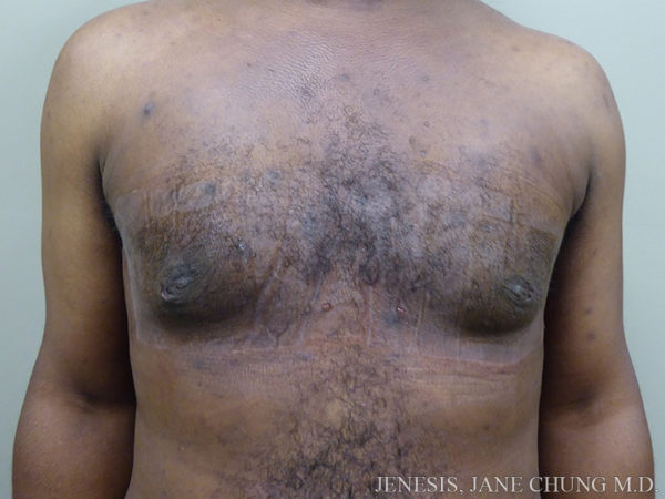 Gynecomastia