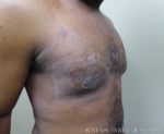 Gynecomastia