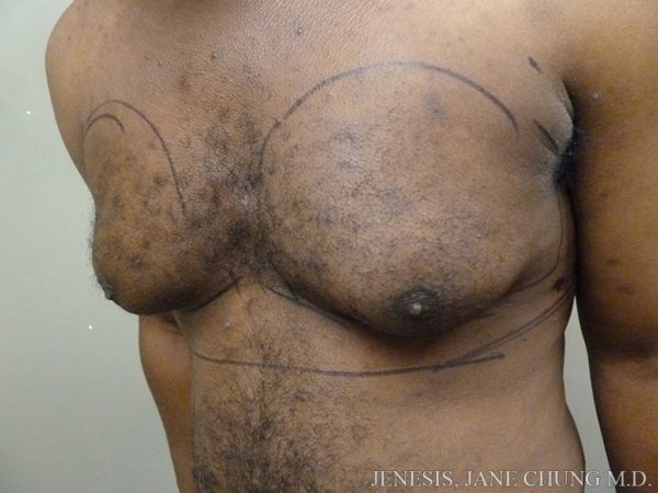 Gynecomastia
